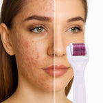 Mikronadel-Roller Set für Hautpflege – Anti-Aging mit Titan-Nadeln