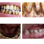 Radiant Teeth – Effective Removal of Plaque and Tartar