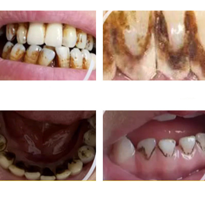Radiant Teeth – Effective Removal of Plaque and Tartar