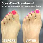 Hallux Valgus Unterstützung – Schmerzfrei und Selbstbewusst Gehen