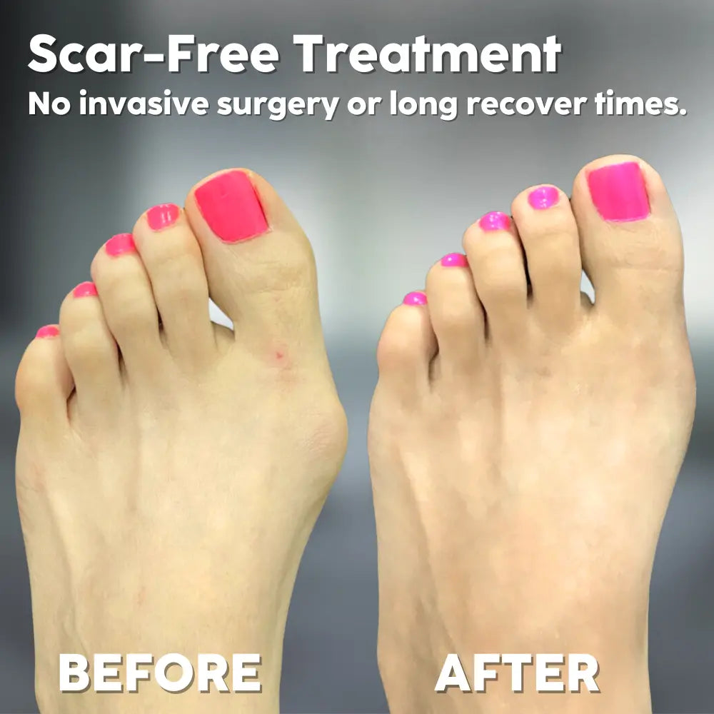 Hallux Valgus Unterstützung – Schmerzfrei und Selbstbewusst Gehen