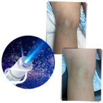 Effective skin therapy device with blue LED lights