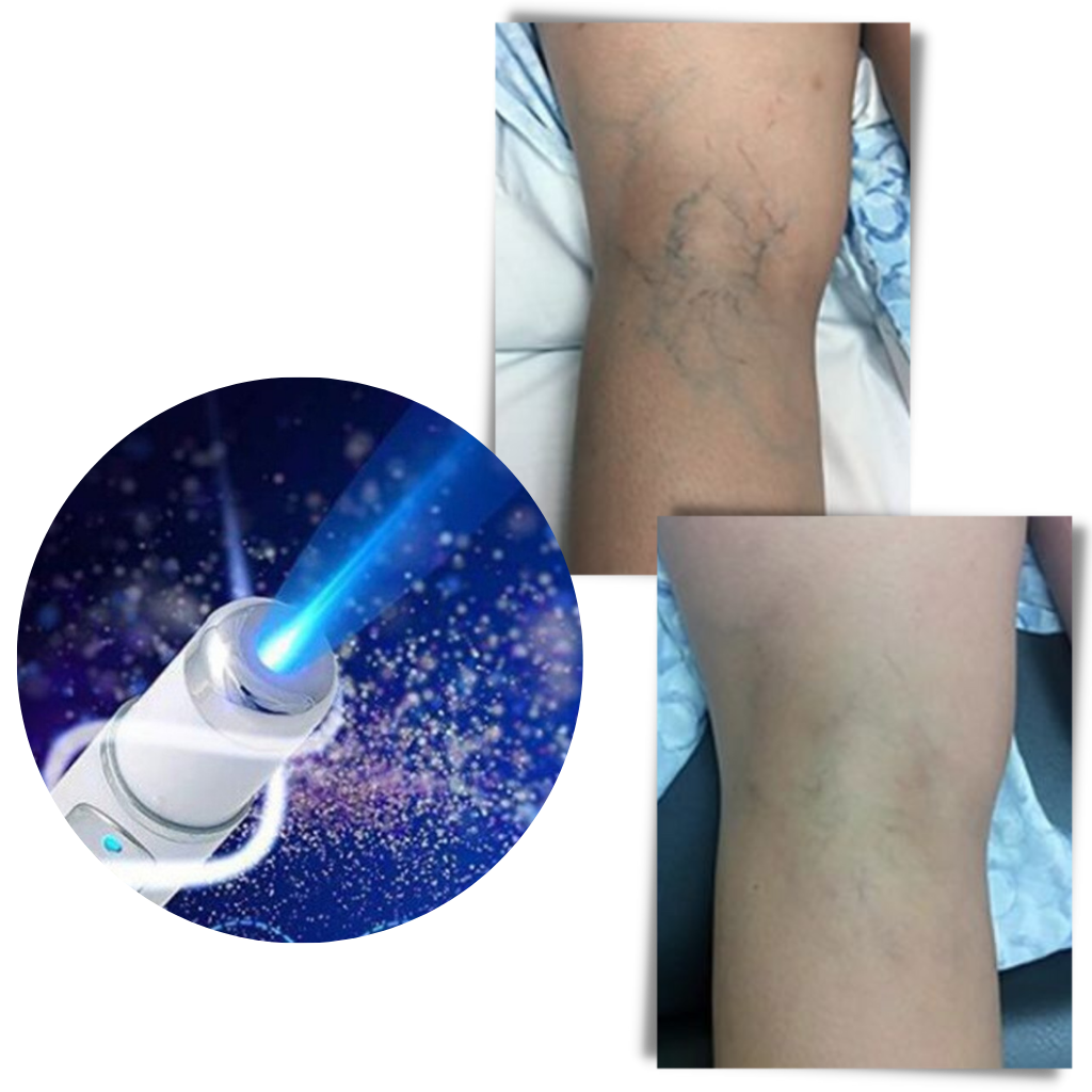 Effective skin therapy device with blue LED lights