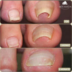 10 Stück + 10 gratis | Sofortige Lösung für Ihre Nagelprobleme