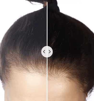 HaarVitalizer™ | Elektronischer Haarverjünger