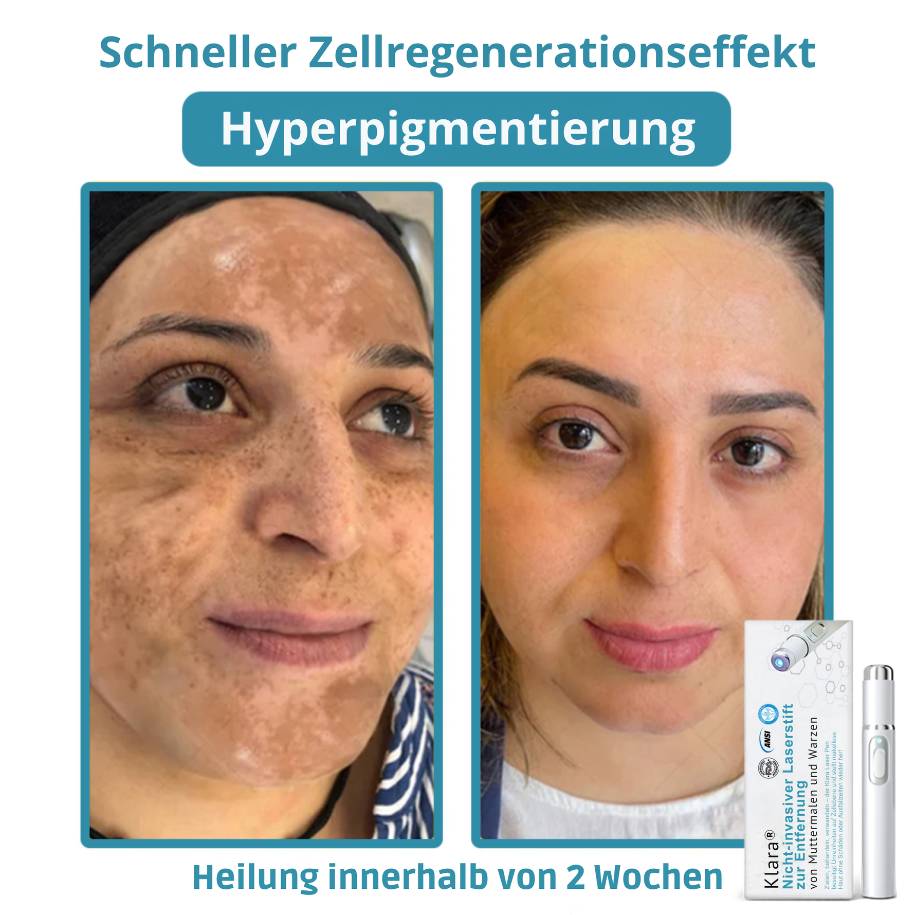 LumiSkin™ Lasergerät für schmerzfreie Hautverjüngung