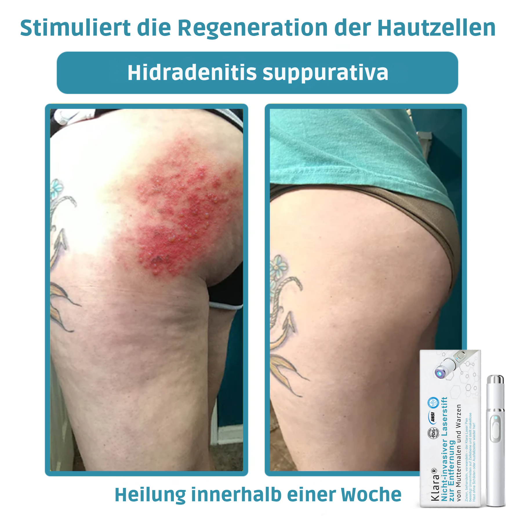 LumiSkin™ Lasergerät für schmerzfreie Hautverjüngung