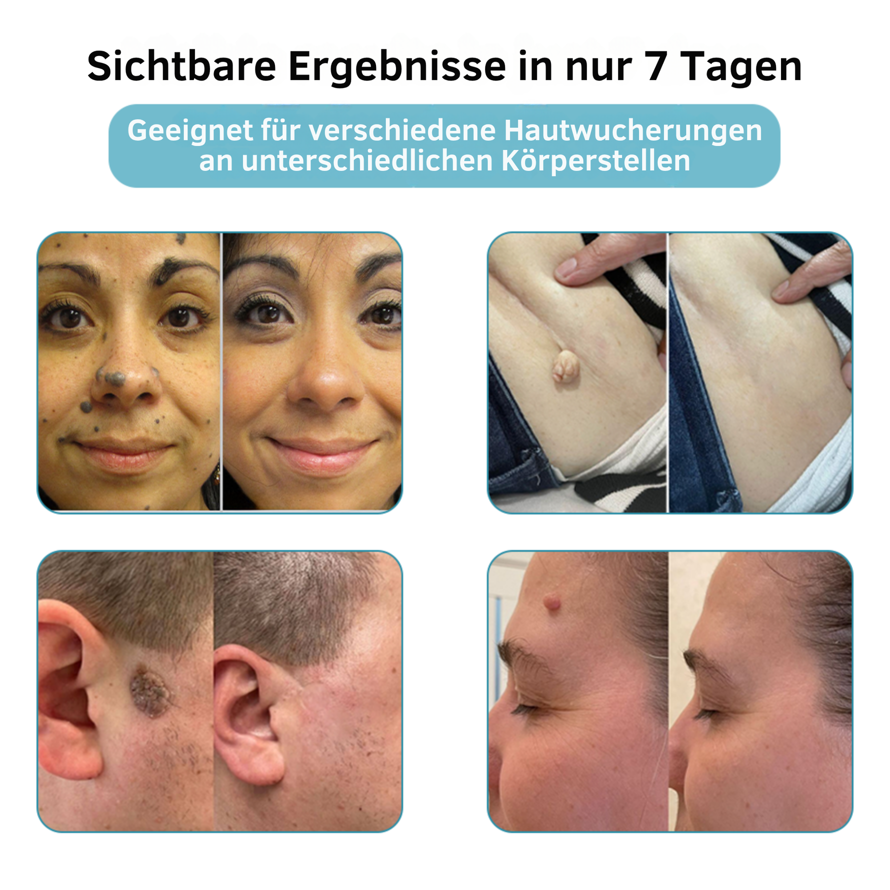 LumiSkin™ Lasergerät für schmerzfreie Hautverjüngung