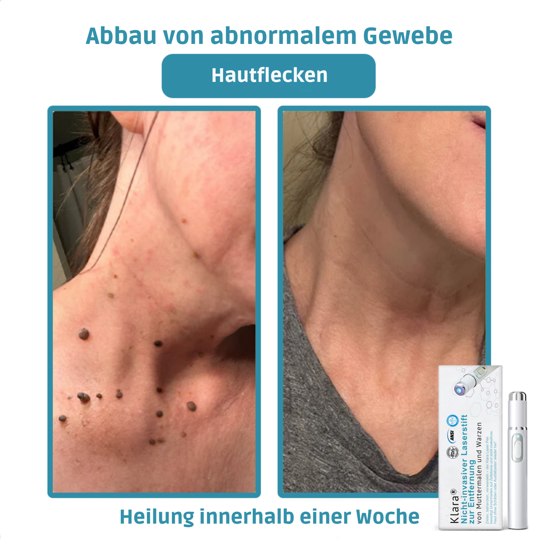 LumiSkin™ Lasergerät für schmerzfreie Hautverjüngung