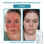 LumiSkin™ Lasergerät für schmerzfreie Hautverjüngung