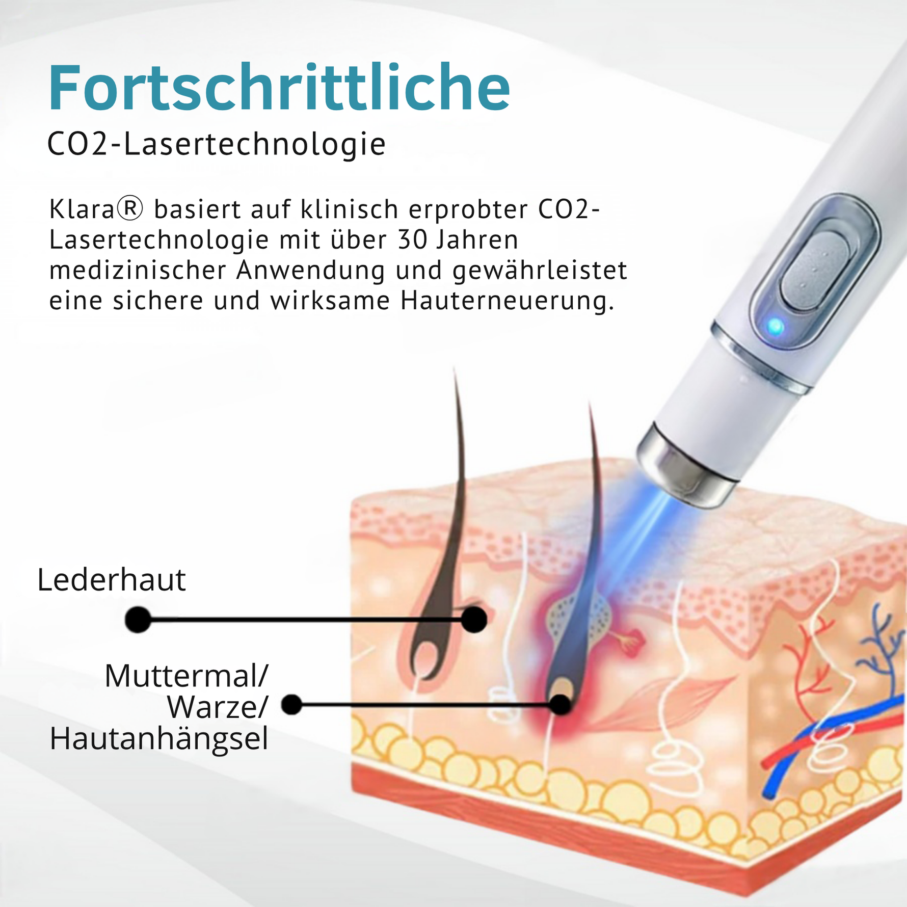 LumiSkin™ Lasergerät für schmerzfreie Hautverjüngung