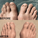 Pilzfrei | Effektive Lasertherapie für gesunde Nägel!