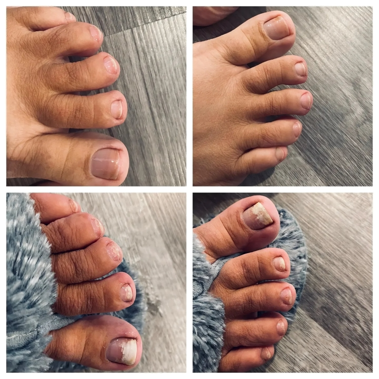 Pilzfrei | Effektive Lasertherapie für gesunde Nägel!