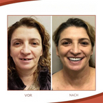 Flexible Denture Set for a worry-free smile