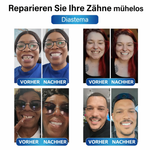 Zahnersatz | Zahnreparaturset mit LED | Formbares Zahngel | SmileCraft