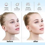 Acne Treatment Wand Fast-Acting & Collagen-Boosting
