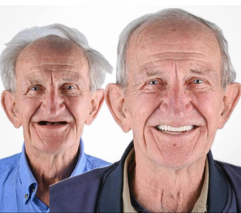 Denture Set Moldable Upper & Lower At-Home Fitting Kit