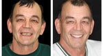 Full Denture Set Moldable Custom-Fit Upper and Lower