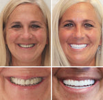 Full Denture Set Moldable Custom-Fit Upper and Lower