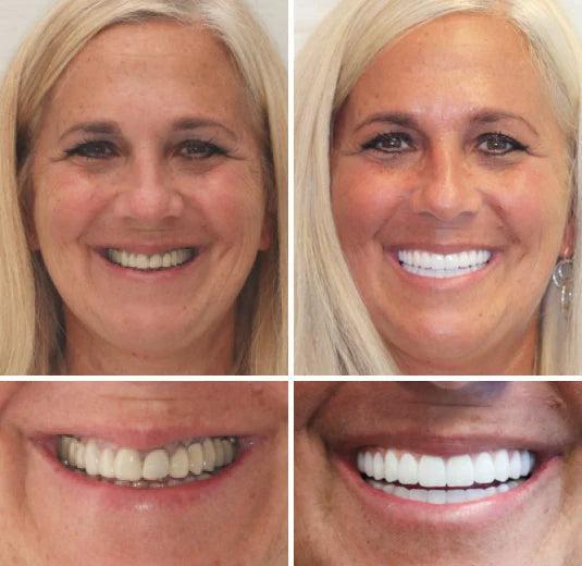 Full Denture Set Moldable Custom-Fit Upper and Lower