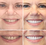 Full Denture Set Moldable Custom-Fit Upper and Lower