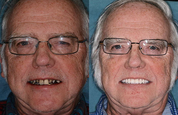 Full Denture Set Moldable Custom-Fit Upper and Lower