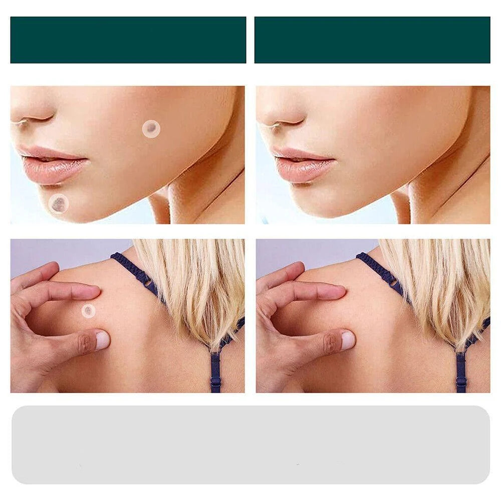 Wart Removal Patches Hydrocolloid Transparent Set of 120