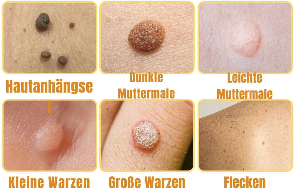 Hautpflegemittel gegen Hautunreinheiten | Schmerzarme Anwendung | Bienenstich-Formel