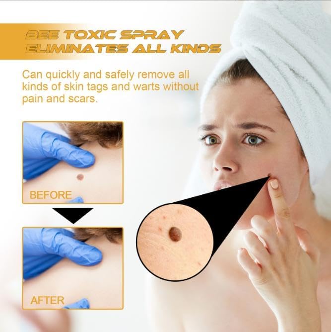Effektives Hautspray gegen Warzen und Hautwucherungen