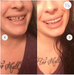 Sofortige Zahnprothese | Lächeln ohne Kleber | Flexibler Sitz | SmileEase