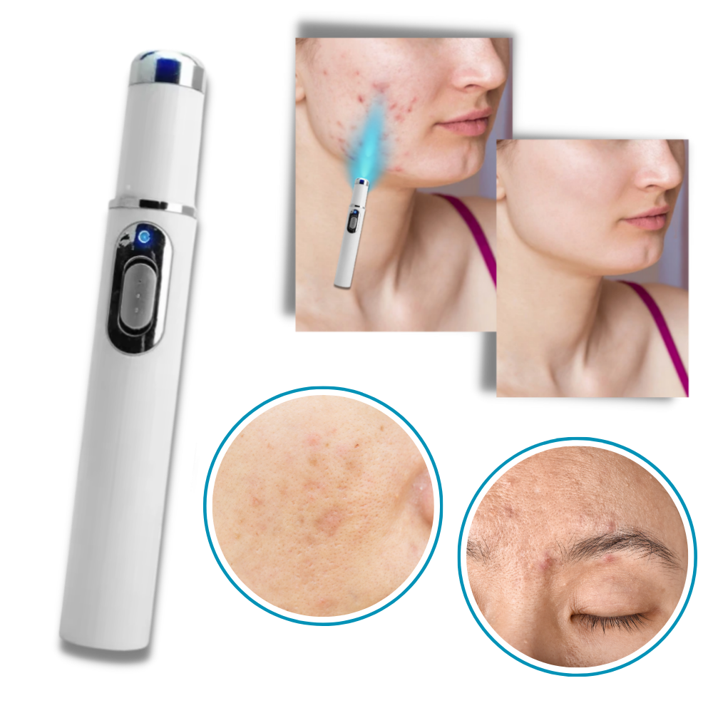 Laser Skincare Pen for Blemish Removal