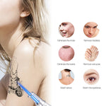 Tattoo Removal Laser Device for Acne, Freckles, and Birthmarks